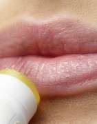 Herpes