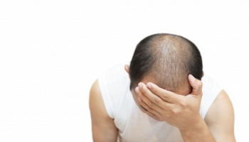 La caída del cabello