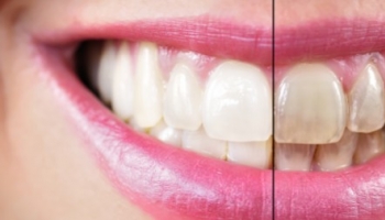 Efectos del tabaco en la salud de los dientes