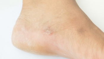 Hongos en los pies, cómo prevenirlos